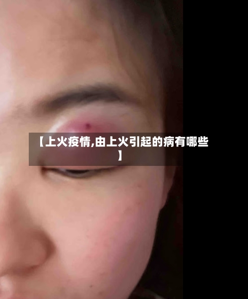 【上火疫情,由上火引起的病有哪些】-第1张图片