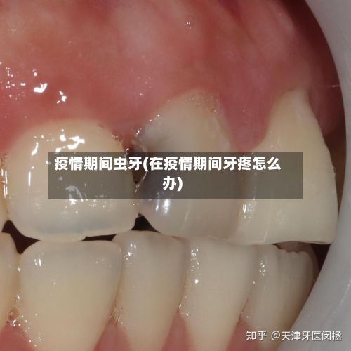 疫情期间虫牙(在疫情期间牙疼怎么办)-第2张图片